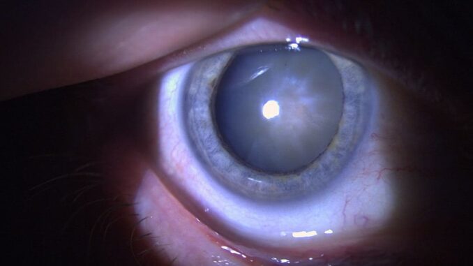 cataracta